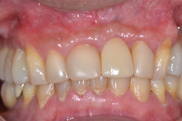 College dental case 2 after