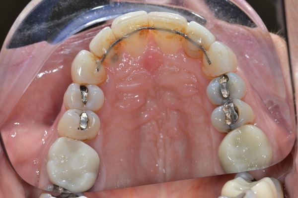 College dental case 4 after