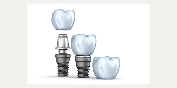 Dental Implants - Process