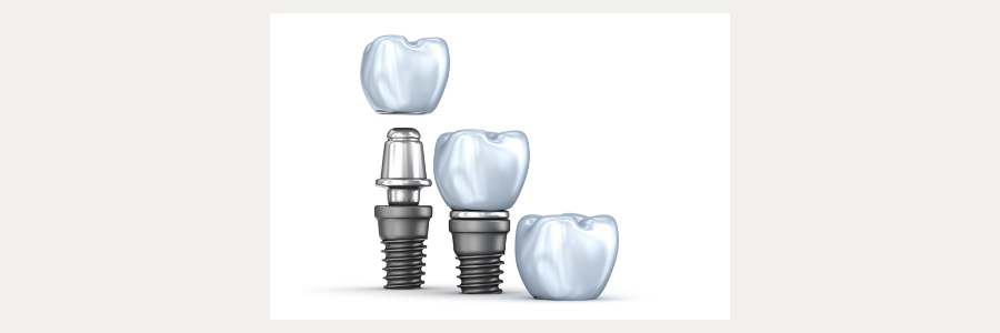 Dental Implants - Process