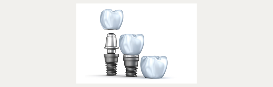 Dental Implants - Process
