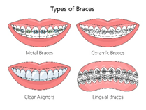 Clear Braces