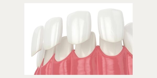 Dental Veneers