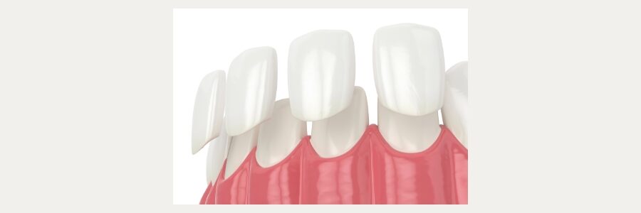 Dental Veneers