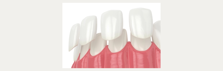 Dental Veneers