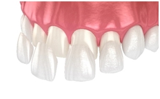veneers