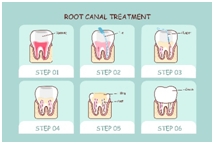 root canal treatment
